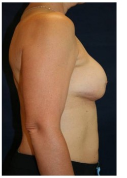 Double Bra Breast Lift Surgery in Portland -Hillsboro Oregon - Mastopexy